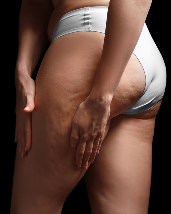 cellulite rimedi