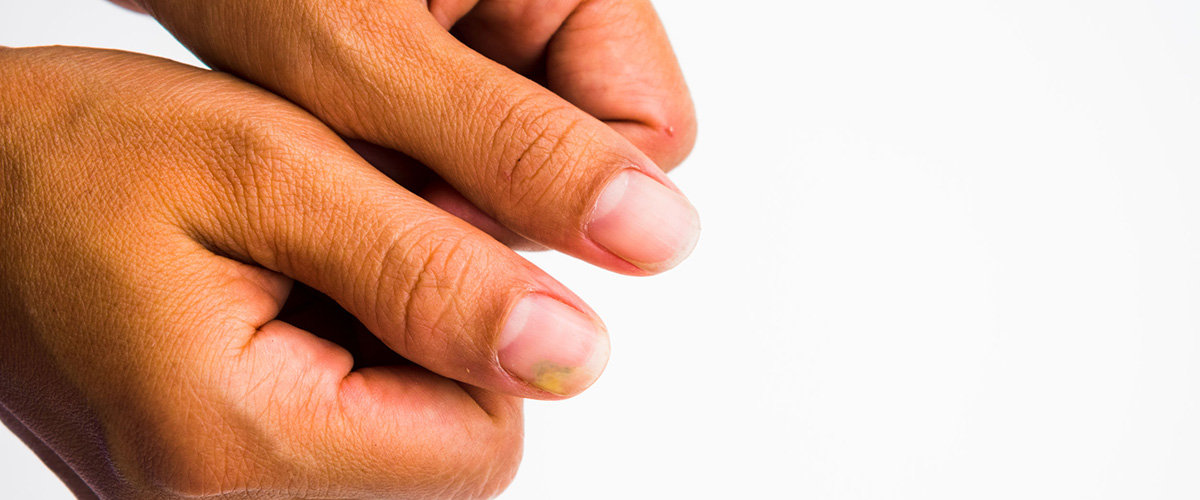 Micosi delle unghie: cause e rimedi 