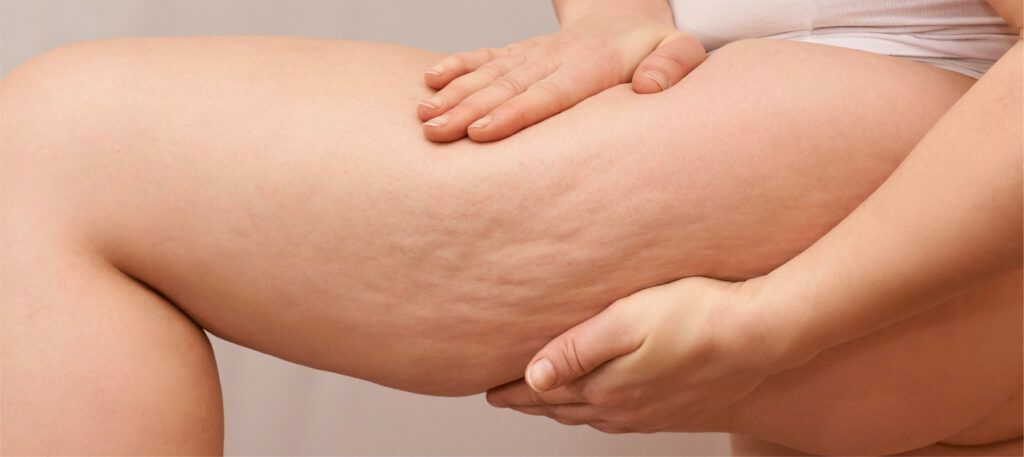 Rimedi cellulite